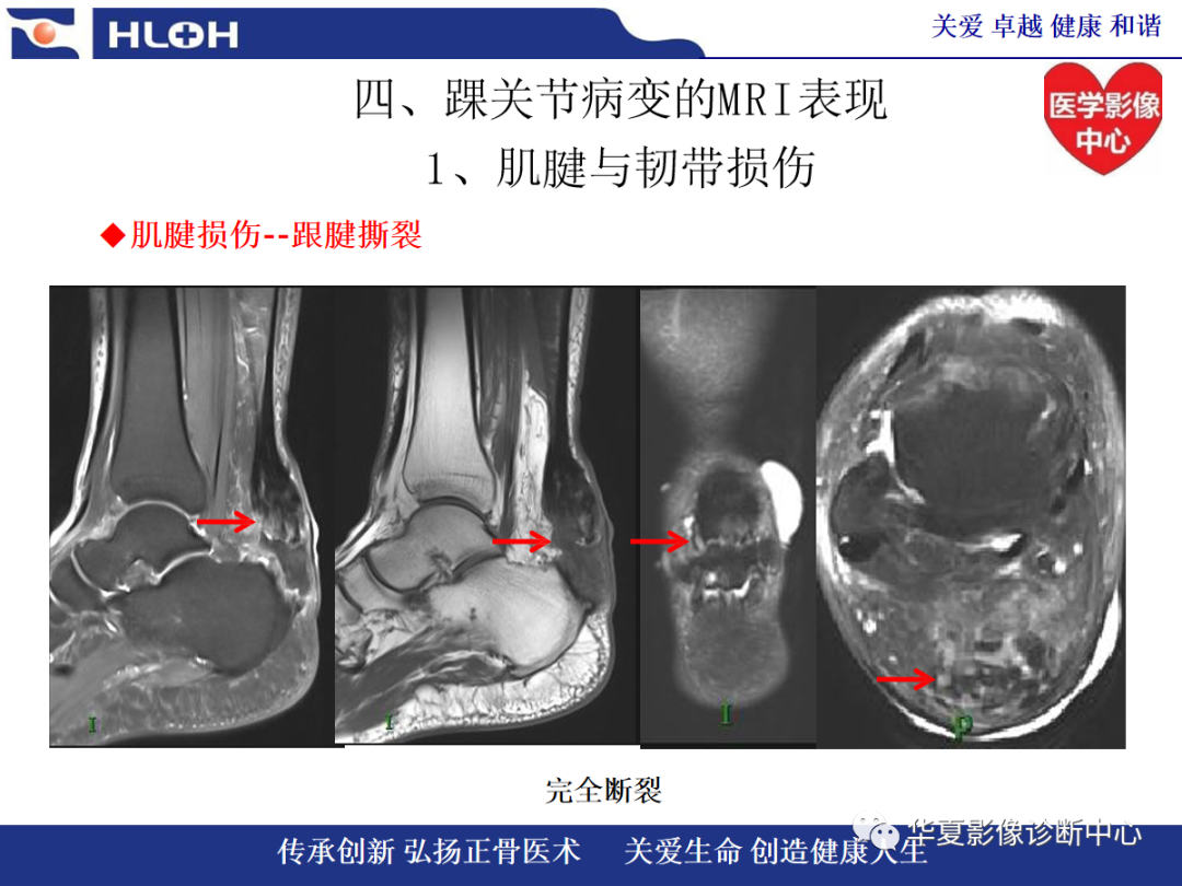 影像PPT - 【PPT】踝关节病变的MRI诊断-57