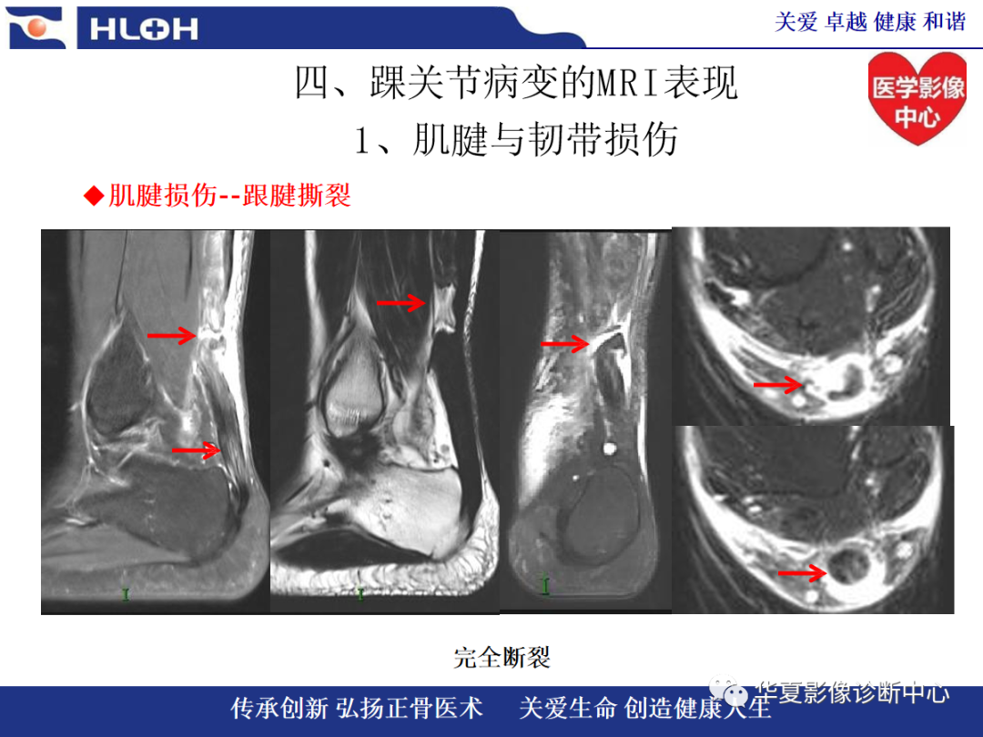 影像PPT - 【PPT】踝关节病变的MRI诊断-58