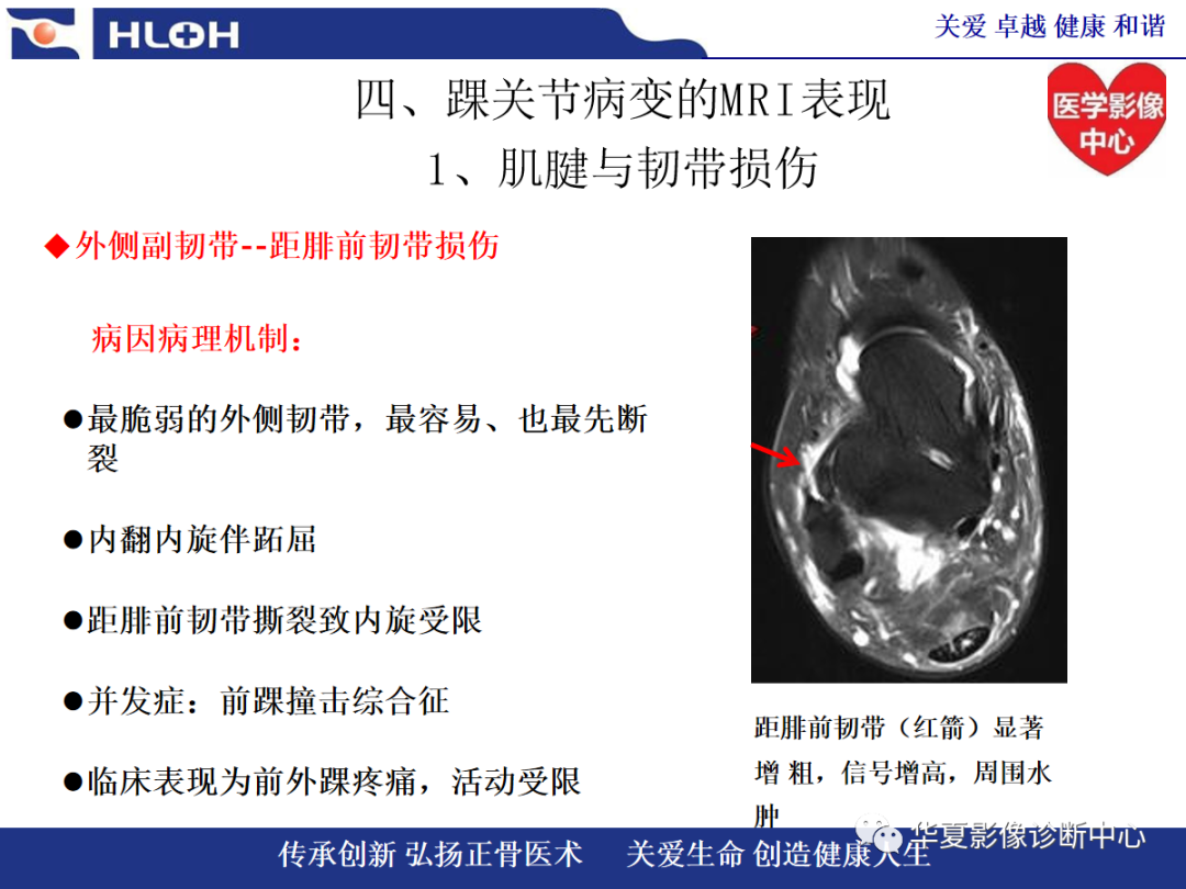 影像PPT - 【PPT】踝关节病变的MRI诊断-62