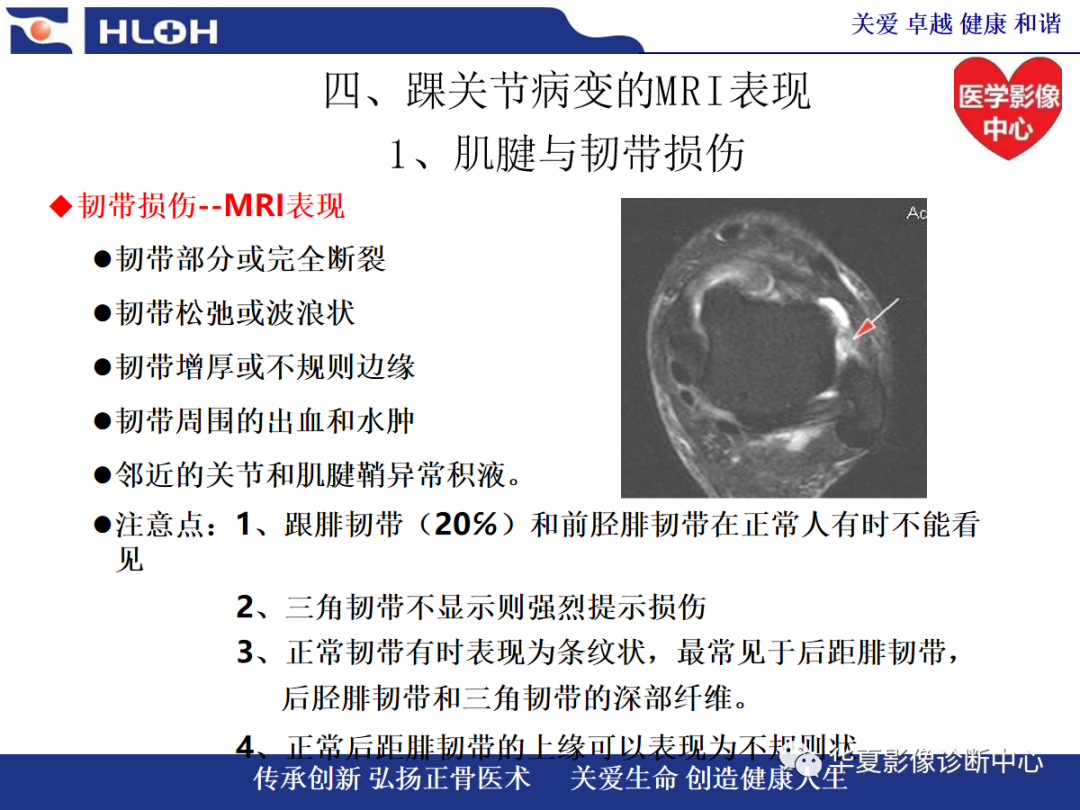 影像PPT - 【PPT】踝关节病变的MRI诊断-61