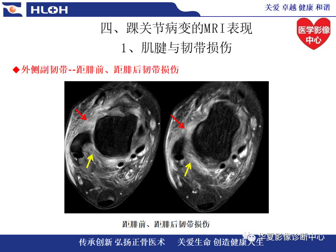 影像PPT - 【PPT】踝关节病变的MRI诊断-65