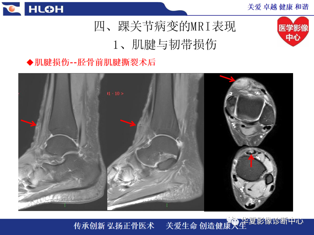 影像PPT - 【PPT】踝关节病变的MRI诊断-43