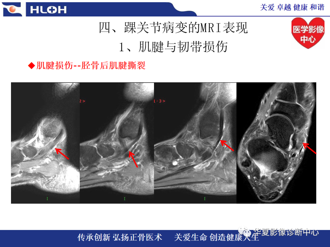影像PPT - 【PPT】踝关节病变的MRI诊断-45