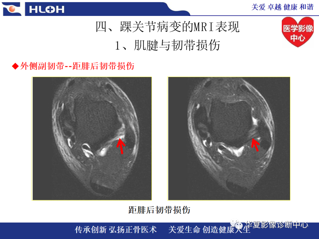 影像PPT - 【PPT】踝关节病变的MRI诊断-66