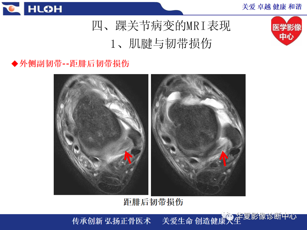 影像PPT - 【PPT】踝关节病变的MRI诊断-67