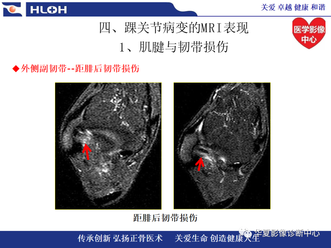 影像PPT - 【PPT】踝关节病变的MRI诊断-68