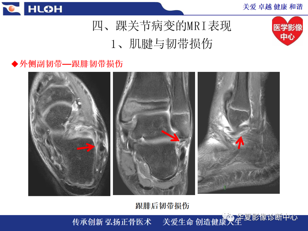 影像PPT - 【PPT】踝关节病变的MRI诊断-69