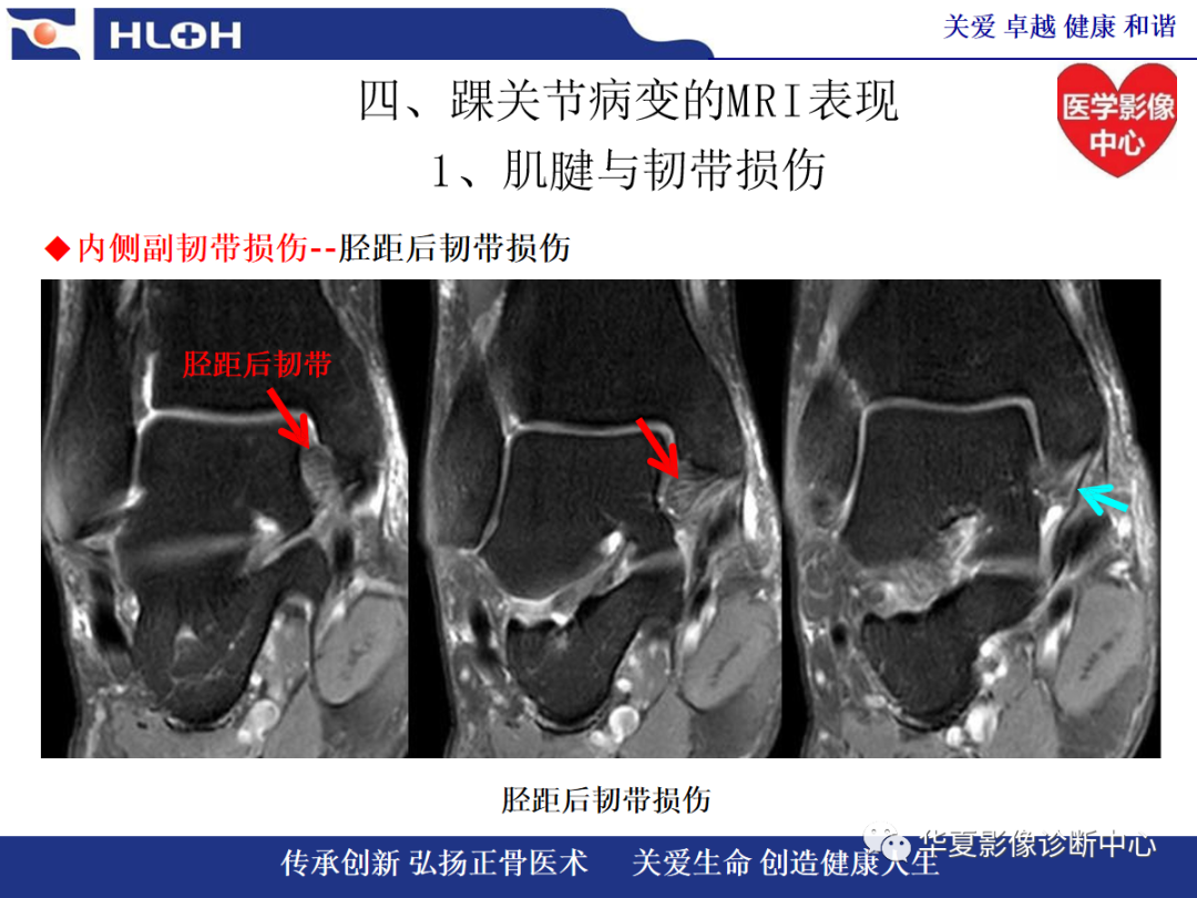 影像PPT - 【PPT】踝关节病变的MRI诊断-71