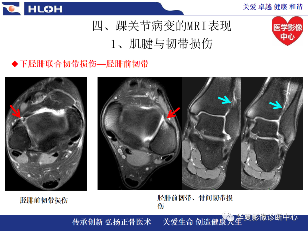 影像PPT - 【PPT】踝关节病变的MRI诊断-76