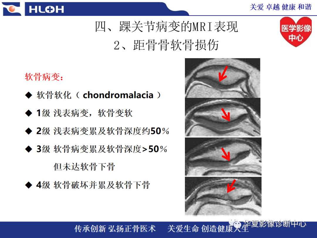 影像PPT - 【PPT】踝关节病变的MRI诊断-78