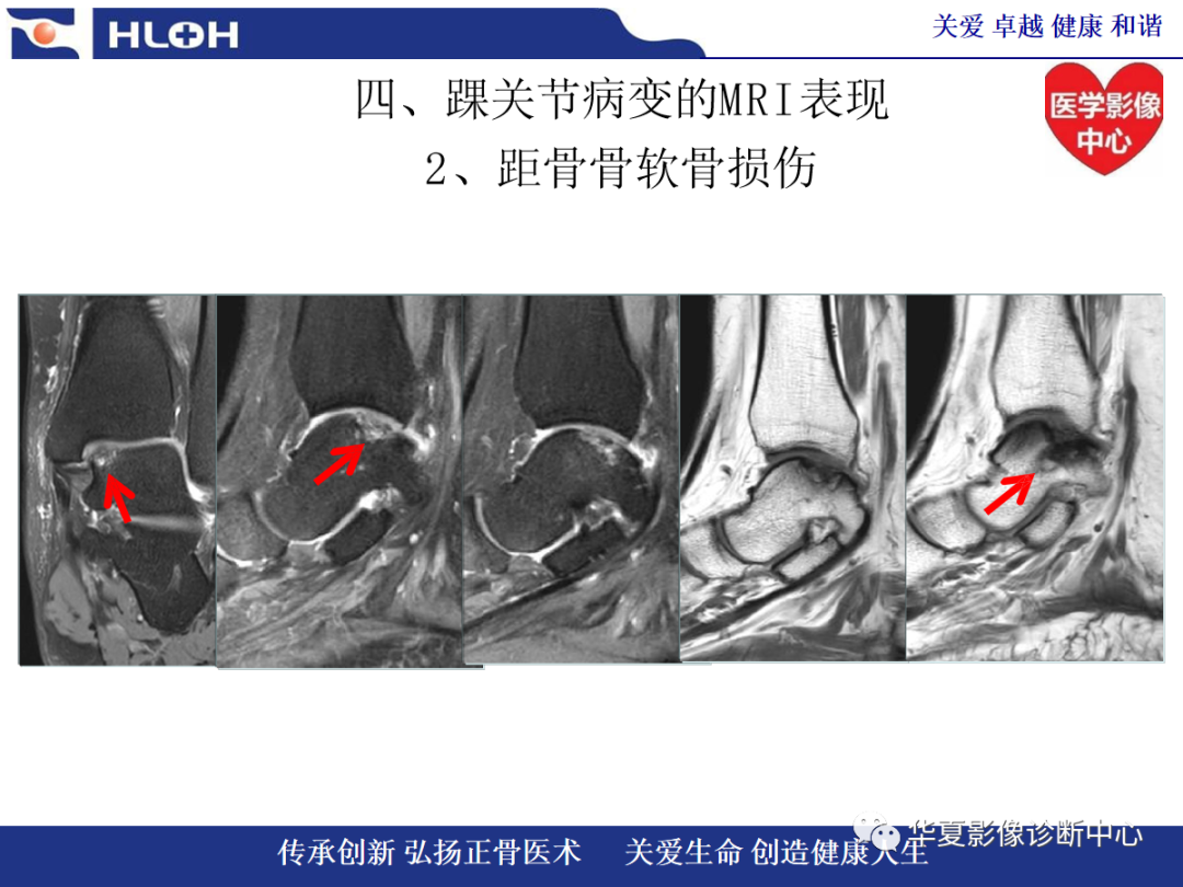 影像PPT - 【PPT】踝关节病变的MRI诊断-82