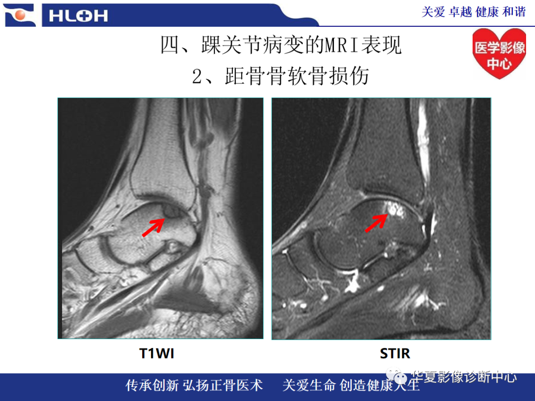 影像PPT - 【PPT】踝关节病变的MRI诊断-81