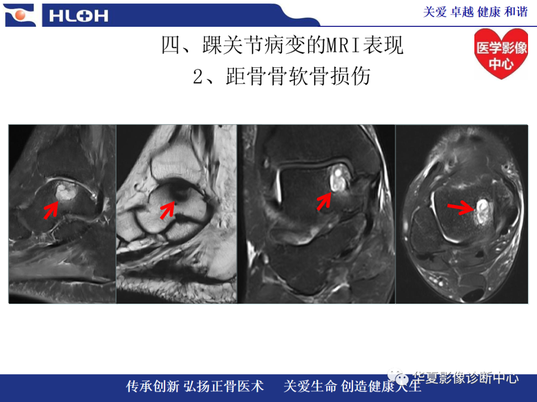 影像PPT - 【PPT】踝关节病变的MRI诊断-85