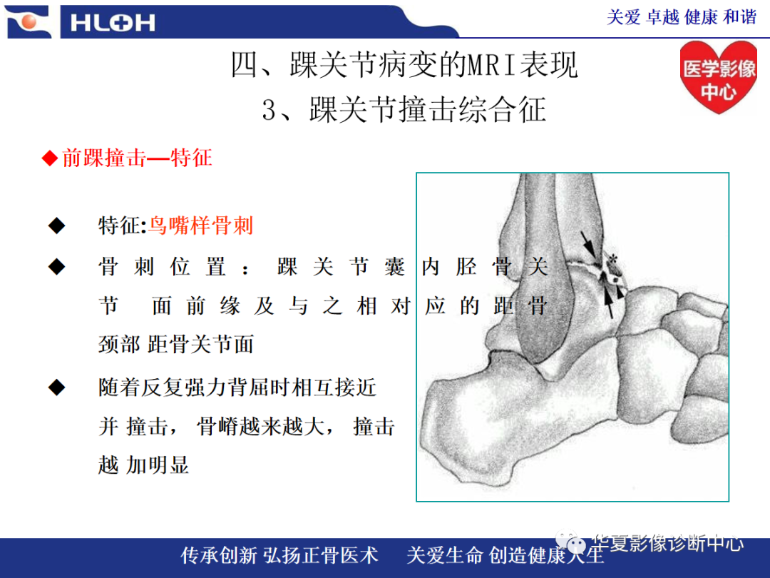 影像PPT - 【PPT】踝关节病变的MRI诊断-91