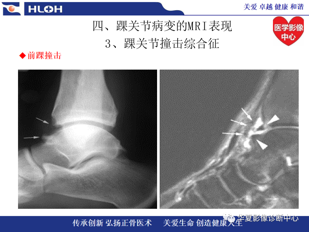 影像PPT - 【PPT】踝关节病变的MRI诊断-93