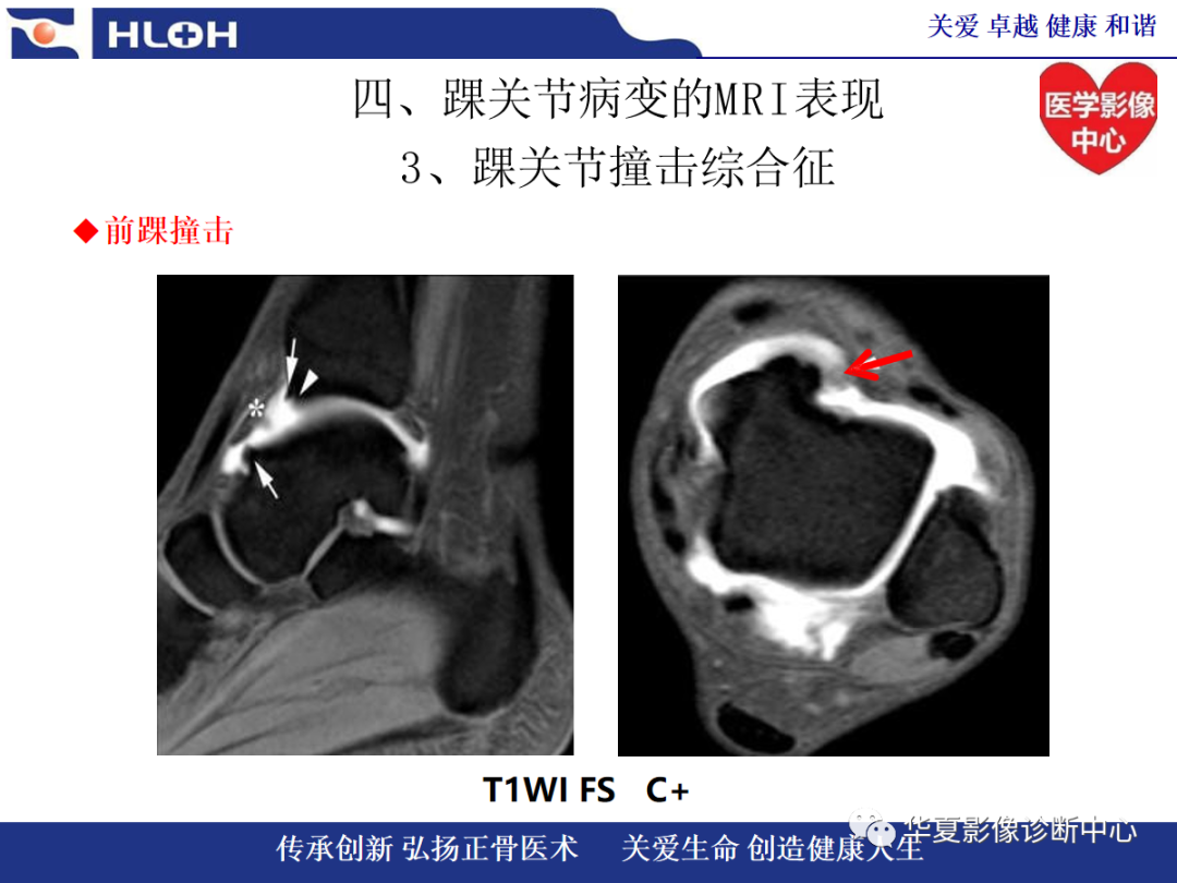 影像PPT - 【PPT】踝关节病变的MRI诊断-94