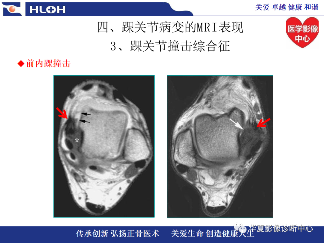 影像PPT - 【PPT】踝关节病变的MRI诊断-103
