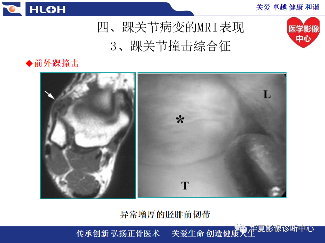 影像PPT - 【PPT】踝关节病变的MRI诊断-100