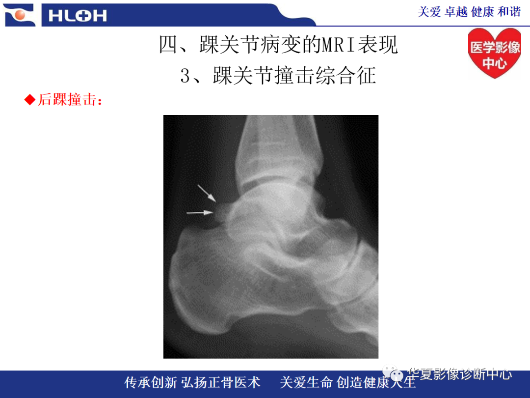 影像PPT - 【PPT】踝关节病变的MRI诊断-106