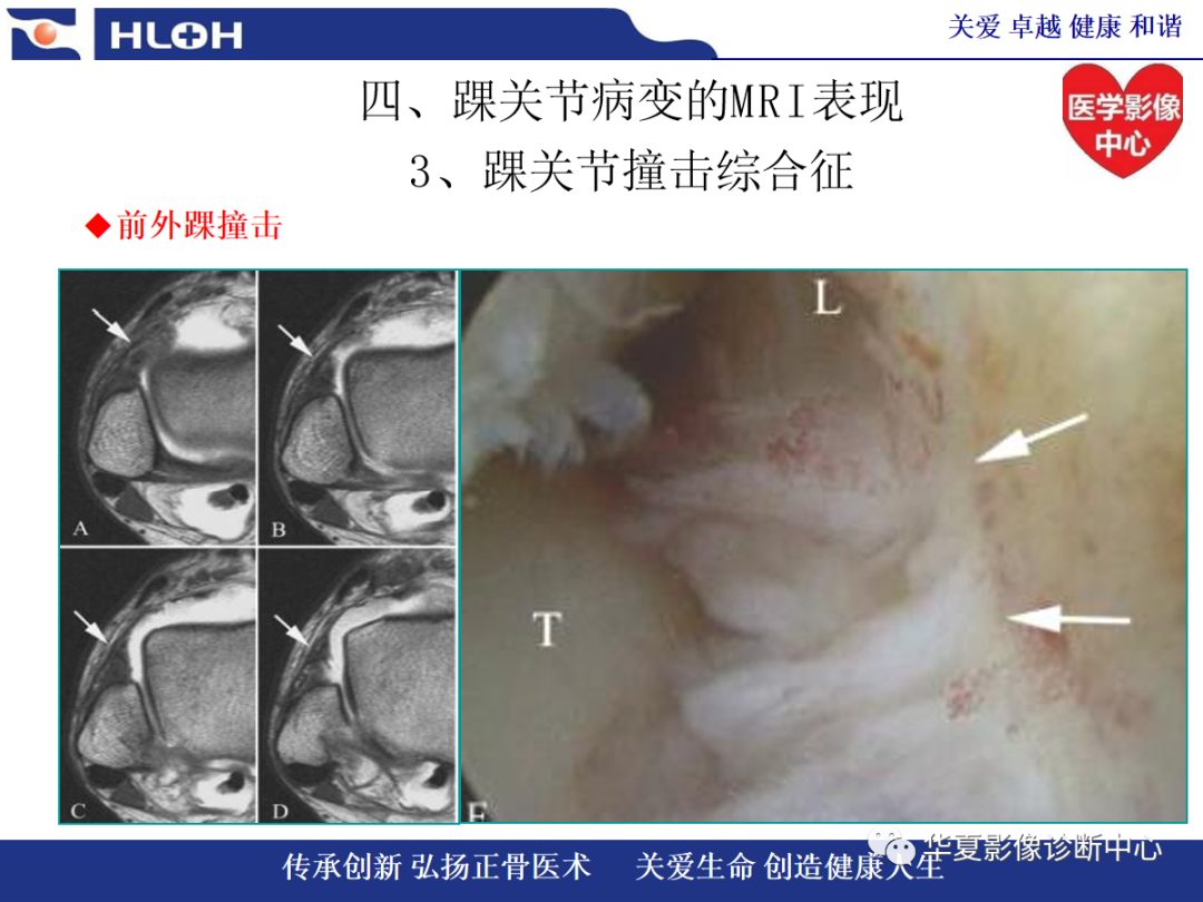 影像PPT - 【PPT】踝关节病变的MRI诊断-99