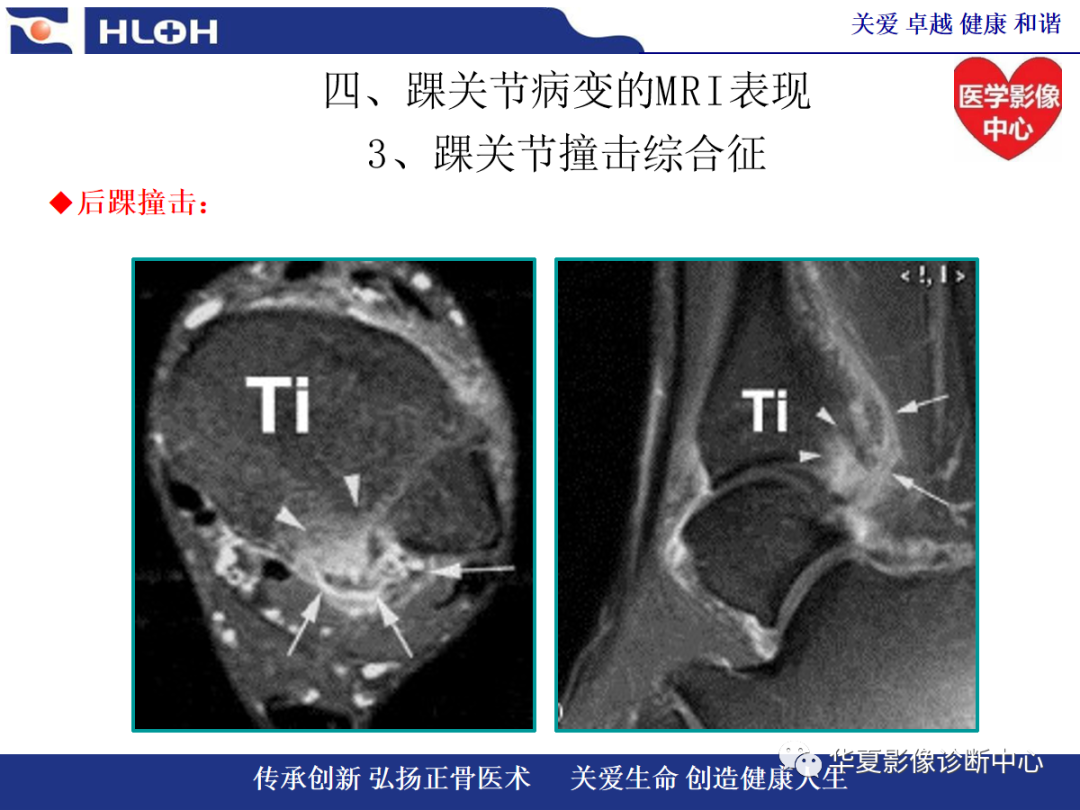 影像PPT - 【PPT】踝关节病变的MRI诊断-107