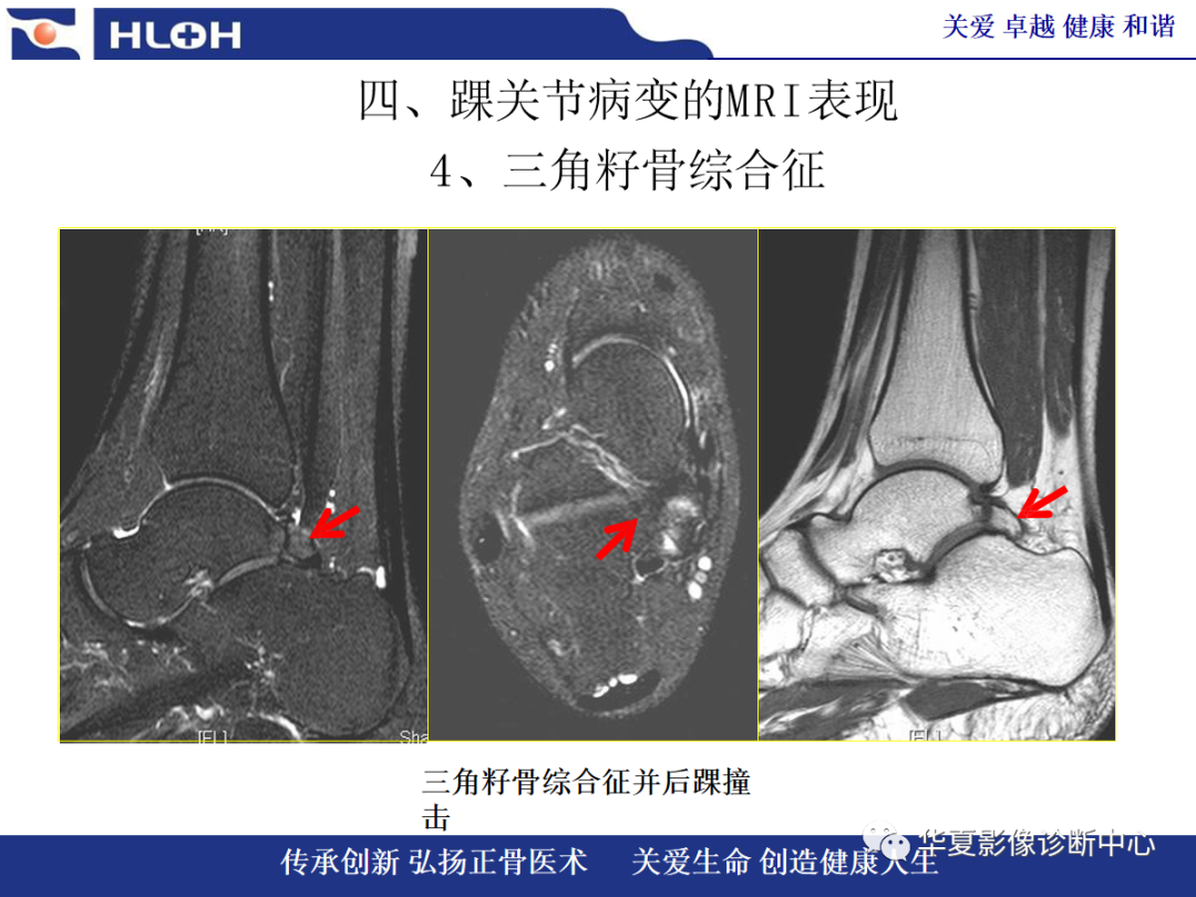 影像PPT - 【PPT】踝关节病变的MRI诊断-111