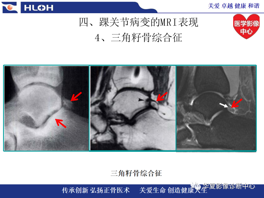 影像PPT - 【PPT】踝关节病变的MRI诊断-112
