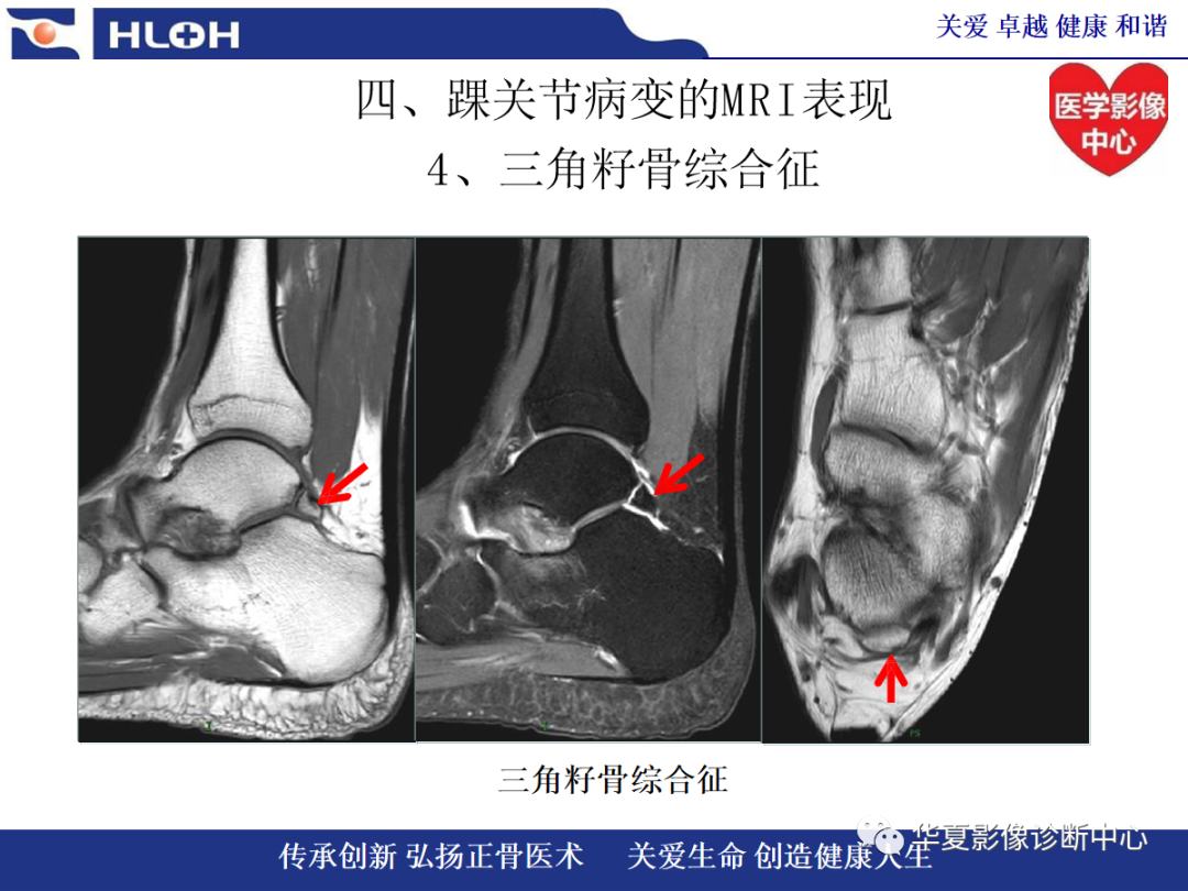 影像PPT - 【PPT】踝关节病变的MRI诊断-113