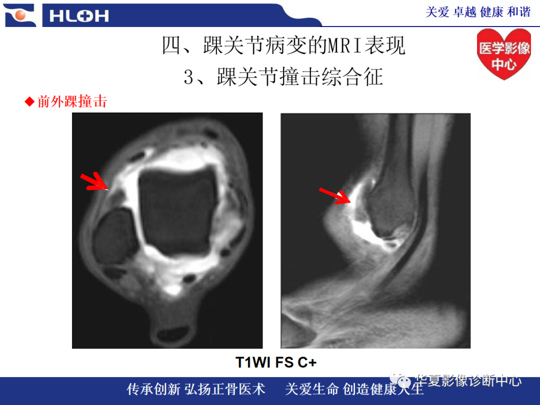 影像PPT - 【PPT】踝关节病变的MRI诊断-98