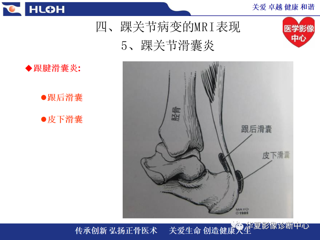 影像PPT - 【PPT】踝关节病变的MRI诊断-115