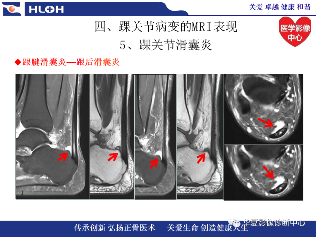 影像PPT - 【PPT】踝关节病变的MRI诊断-116