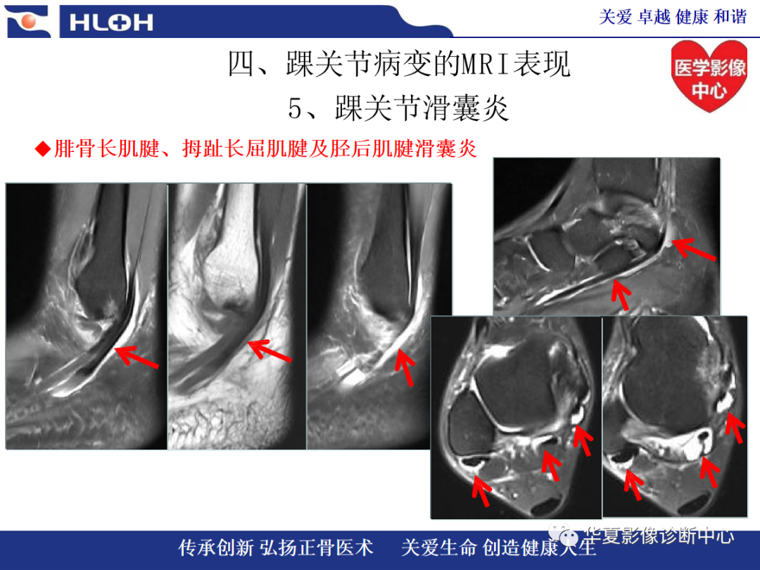影像PPT - 【PPT】踝关节病变的MRI诊断-118