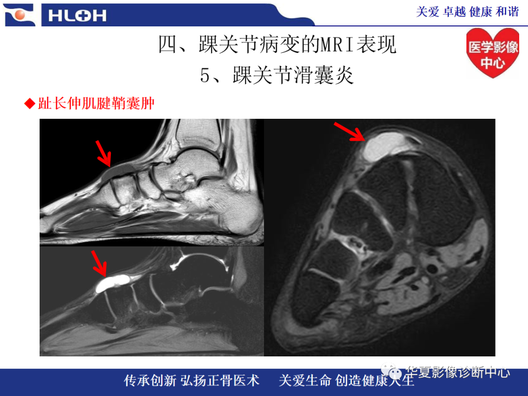 影像PPT - 【PPT】踝关节病变的MRI诊断-119