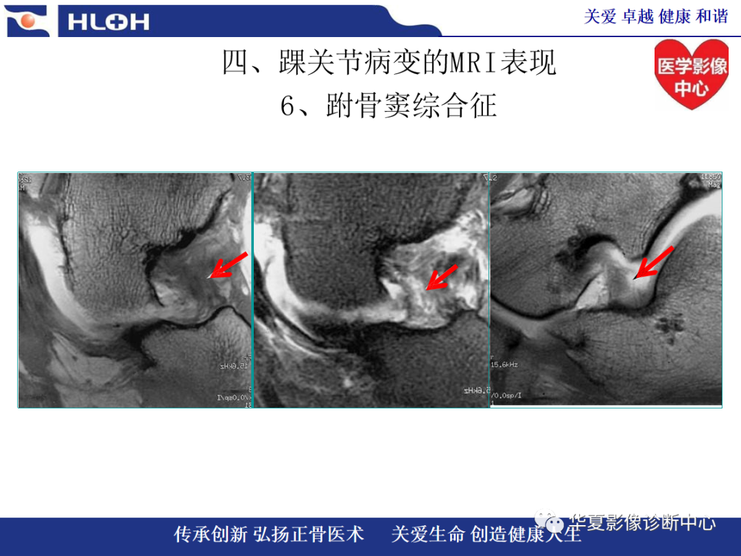 影像PPT - 【PPT】踝关节病变的MRI诊断-124