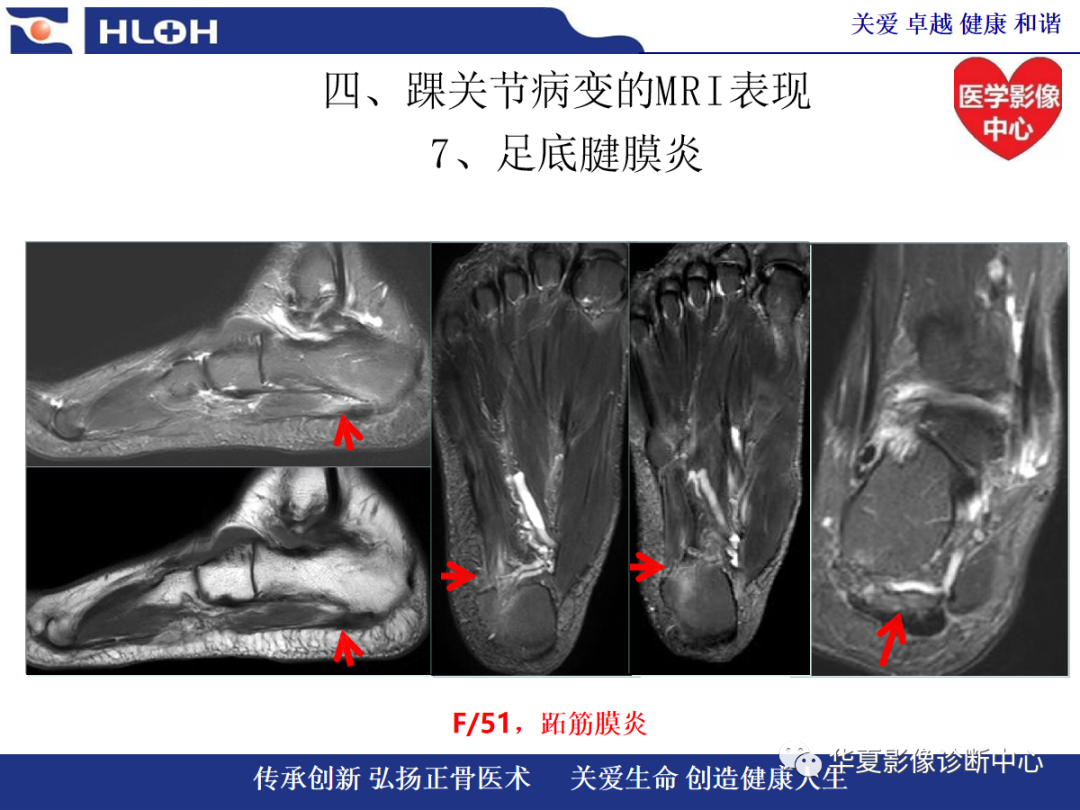 影像PPT - 【PPT】踝关节病变的MRI诊断-127