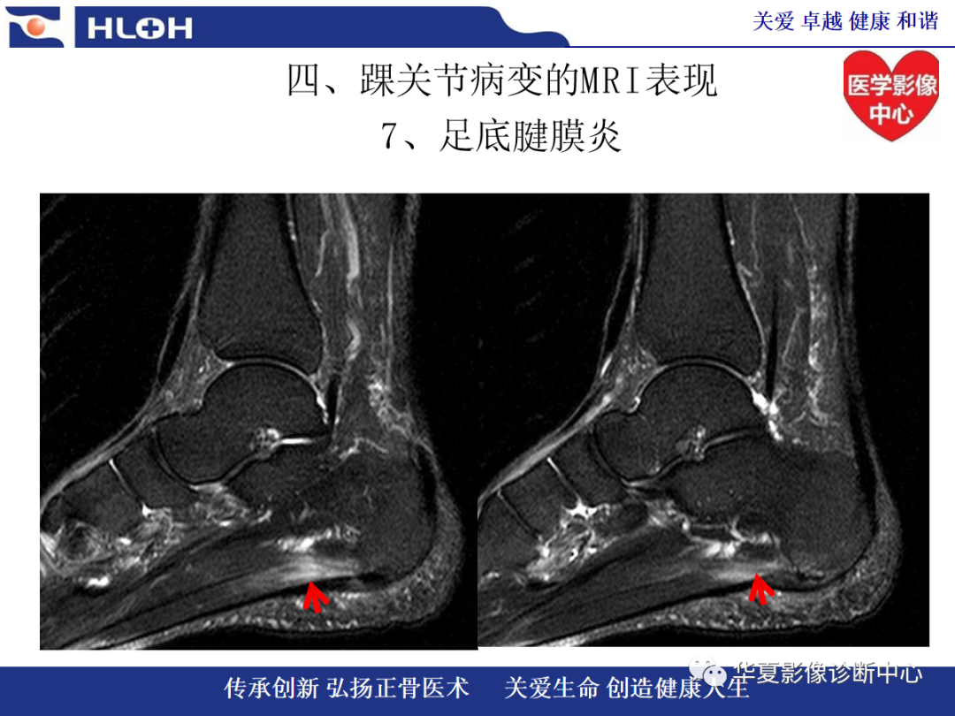 影像PPT - 【PPT】踝关节病变的MRI诊断-128