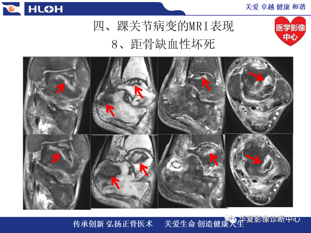 影像PPT - 【PPT】踝关节病变的MRI诊断-131