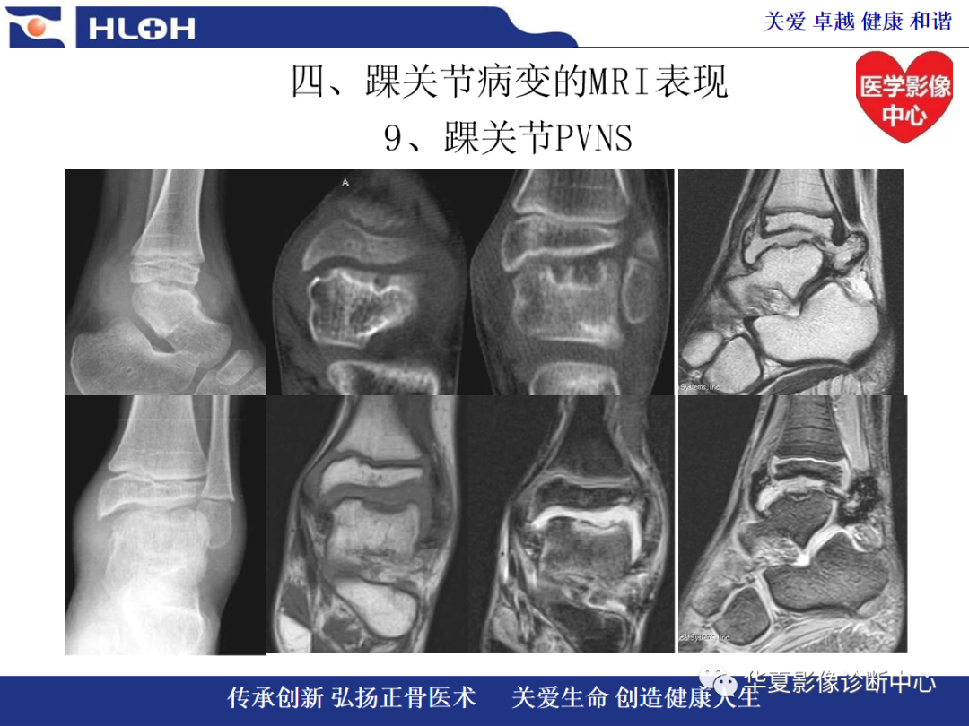 影像PPT - 【PPT】踝关节病变的MRI诊断-135