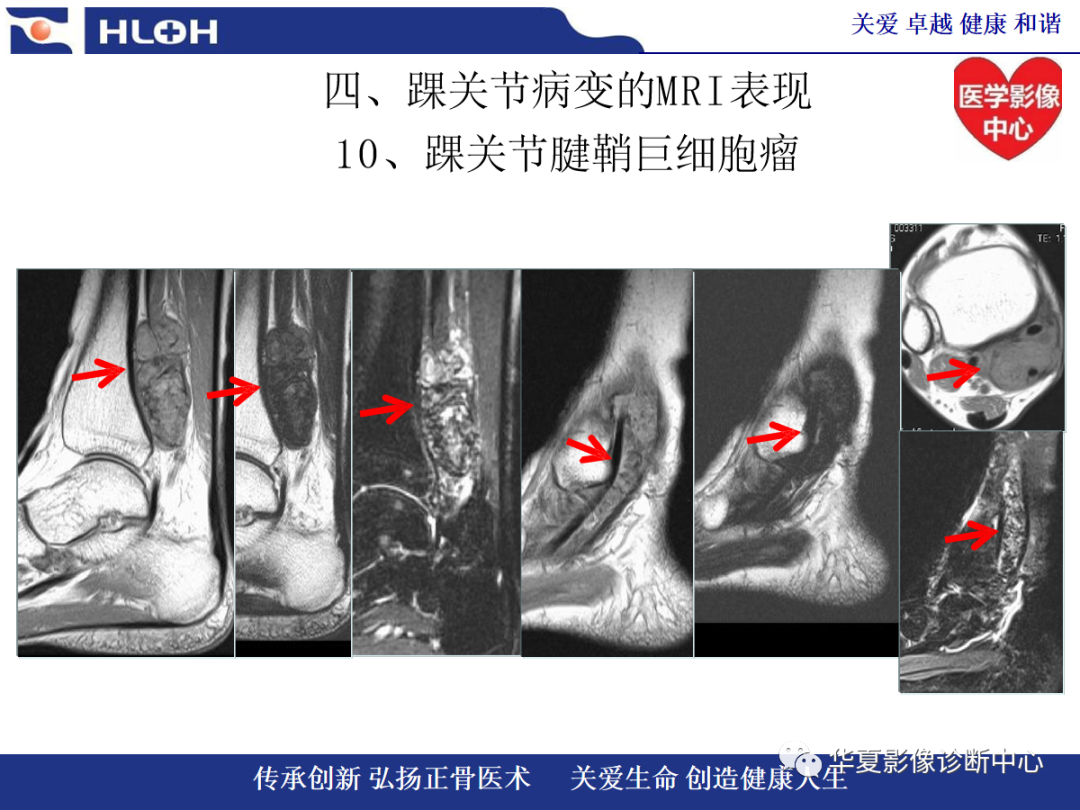 影像PPT - 【PPT】踝关节病变的MRI诊断-138