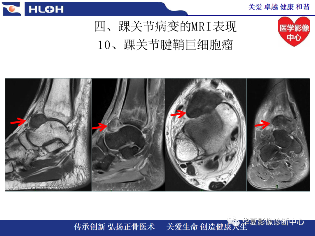 影像PPT - 【PPT】踝关节病变的MRI诊断-139