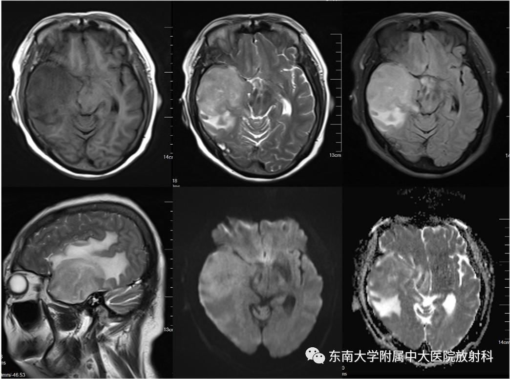 影像PPT - 【PPT】原发性中枢神经系统淋巴瘤-2 影像PPT - 【PPT】原发性中枢神经系统淋巴瘤-2