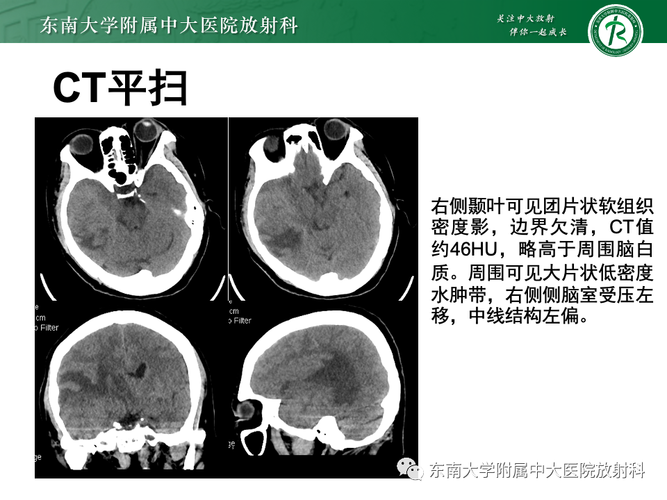 影像PPT - 【PPT】原发性中枢神经系统淋巴瘤-5 影像PPT - 【PPT】原发性中枢神经系统淋巴瘤-5