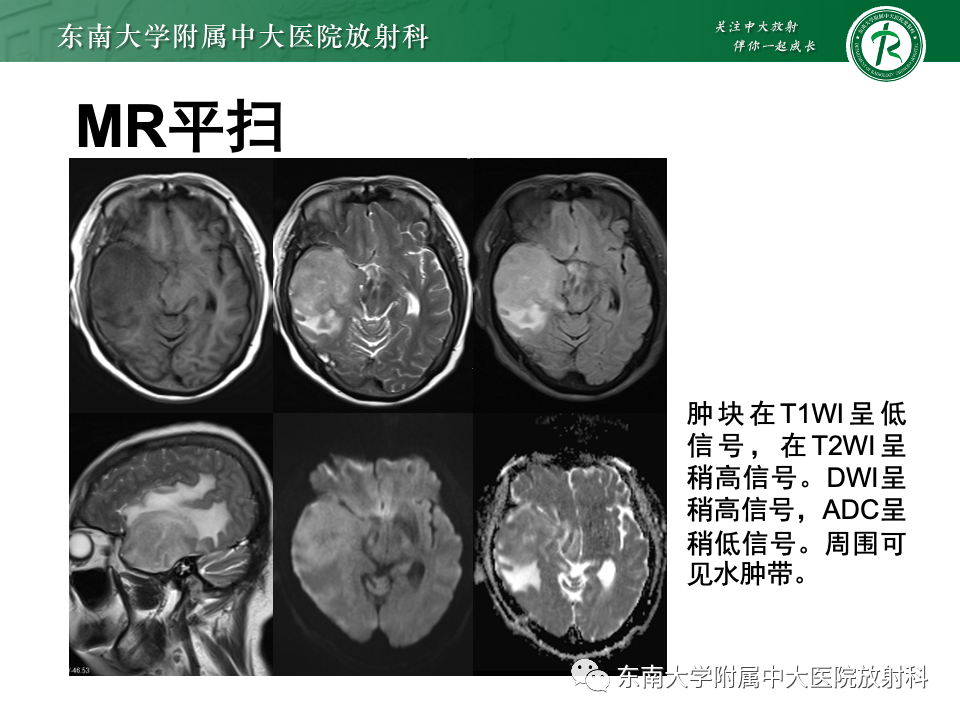 影像PPT - 【PPT】原发性中枢神经系统淋巴瘤-6 影像PPT - 【PPT】原发性中枢神经系统淋巴瘤-6