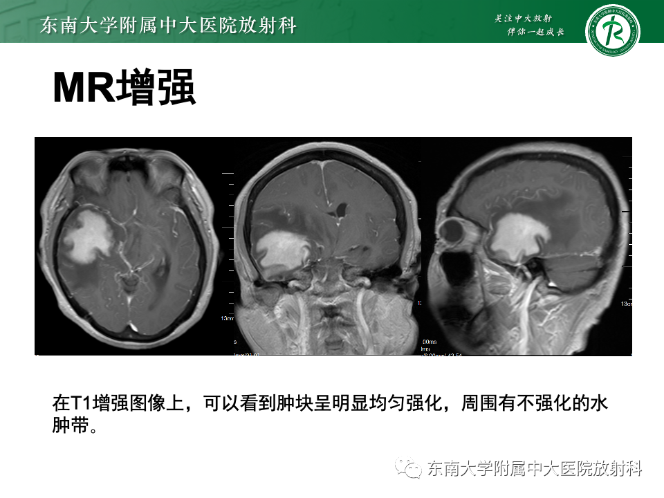 影像PPT - 【PPT】原发性中枢神经系统淋巴瘤-7 影像PPT - 【PPT】原发性中枢神经系统淋巴瘤-7