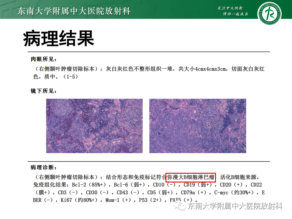 影像PPT - 【PPT】原发性中枢神经系统淋巴瘤-8 影像PPT - 【PPT】原发性中枢神经系统淋巴瘤-8