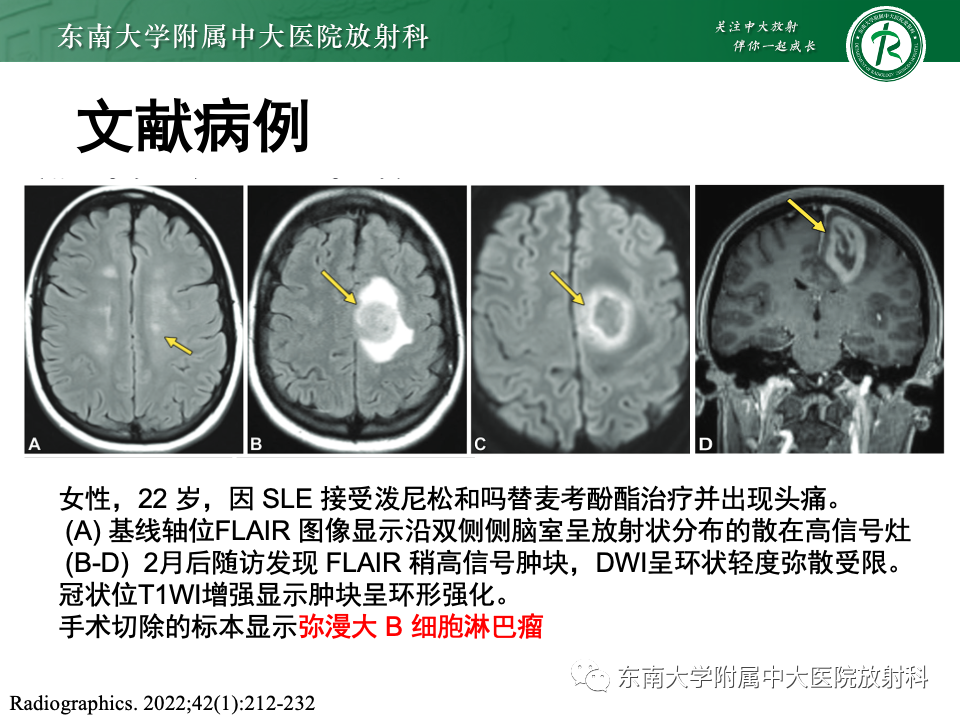 影像PPT - 【PPT】原发性中枢神经系统淋巴瘤-9 影像PPT - 【PPT】原发性中枢神经系统淋巴瘤-9