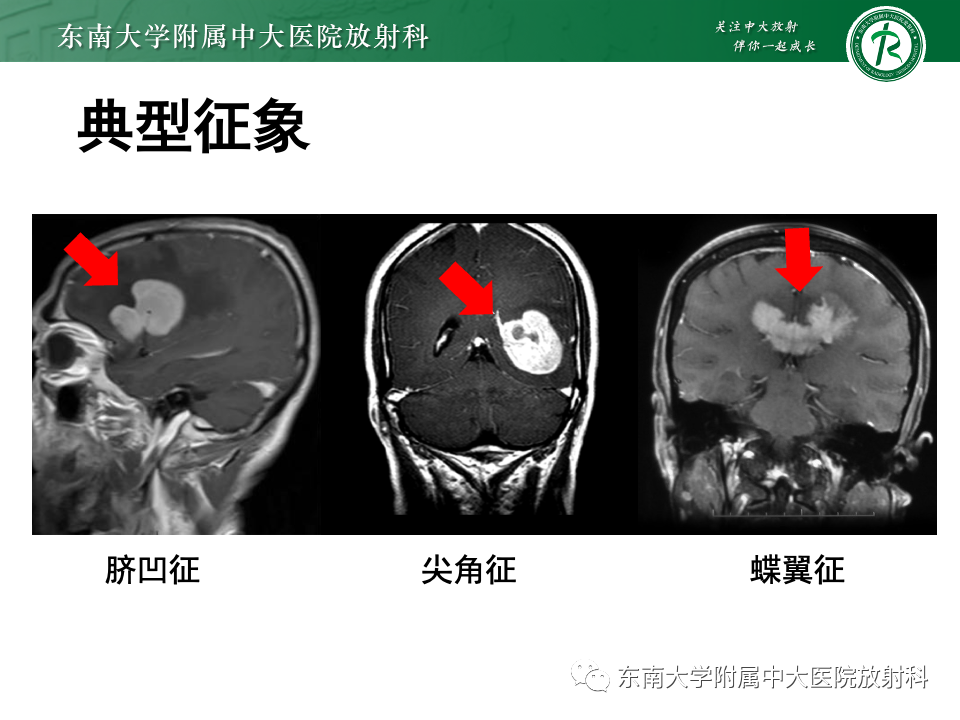 影像PPT - 【PPT】原发性中枢神经系统淋巴瘤-15 影像PPT - 【PPT】原发性中枢神经系统淋巴瘤-15