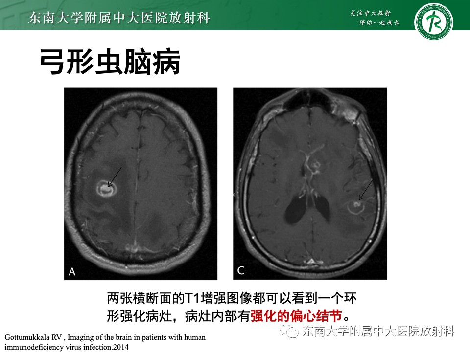 影像PPT - 【PPT】原发性中枢神经系统淋巴瘤-20 影像PPT - 【PPT】原发性中枢神经系统淋巴瘤-20