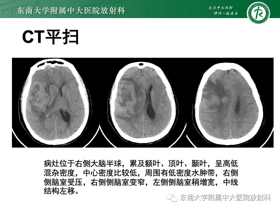 影像PPT - 【PPT】原发性中枢神经系统淋巴瘤-24 影像PPT - 【PPT】原发性中枢神经系统淋巴瘤-24