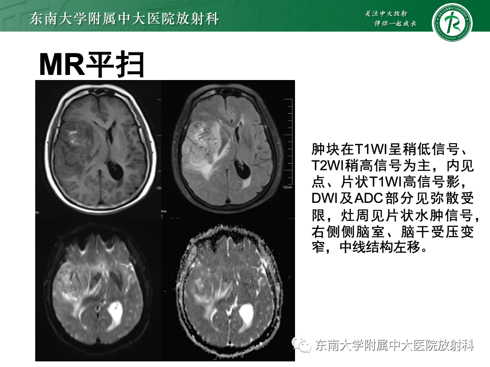 影像PPT - 【PPT】原发性中枢神经系统淋巴瘤-25 影像PPT - 【PPT】原发性中枢神经系统淋巴瘤-25